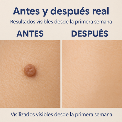 REMOVEDOR DE VERRUGA