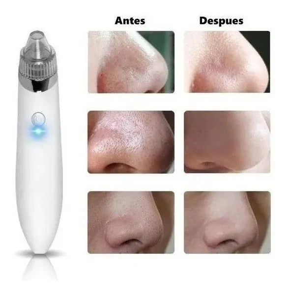 Succionador puntos negros